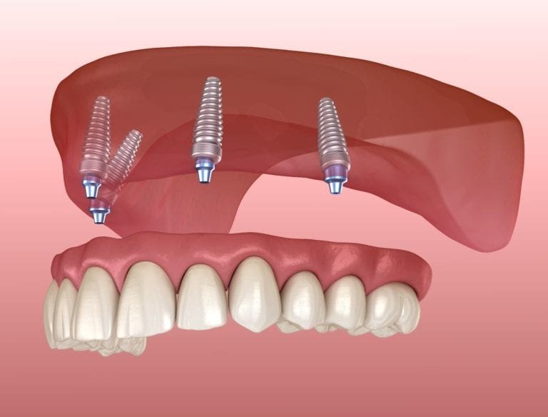 Dentures