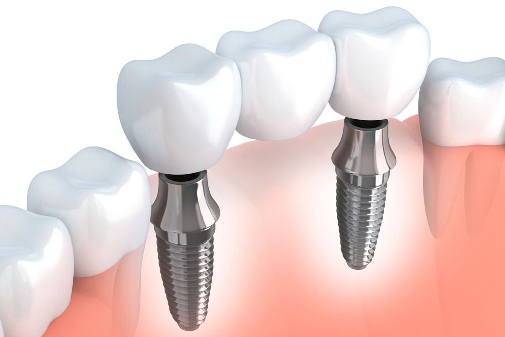 Fixed-Dental-Bridge